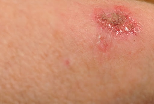 When to Keep Wounds Moist or Dry? - DeLand Foot & Leg Center