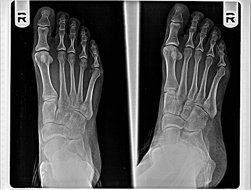 Stress Fractures