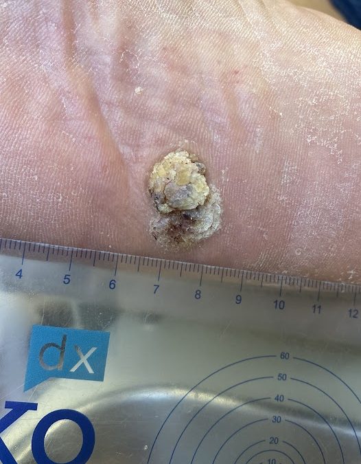 Squamous Cell Carcinoma In Situ